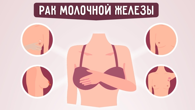 Мужчины тоже плачут: что такое рак груди и откуда он берется. Инфографика